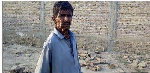 В Пакистане обнаружили отшельника с сотнями опухолей на теле