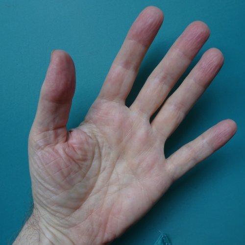Врачи рассказали о болезнях, которые можно определить взглянув на руки человека