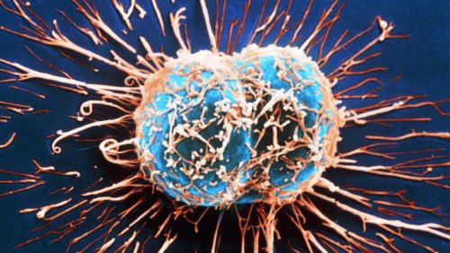 Учёные: Рак кишечника научился «прятаться» от иммунотерапии