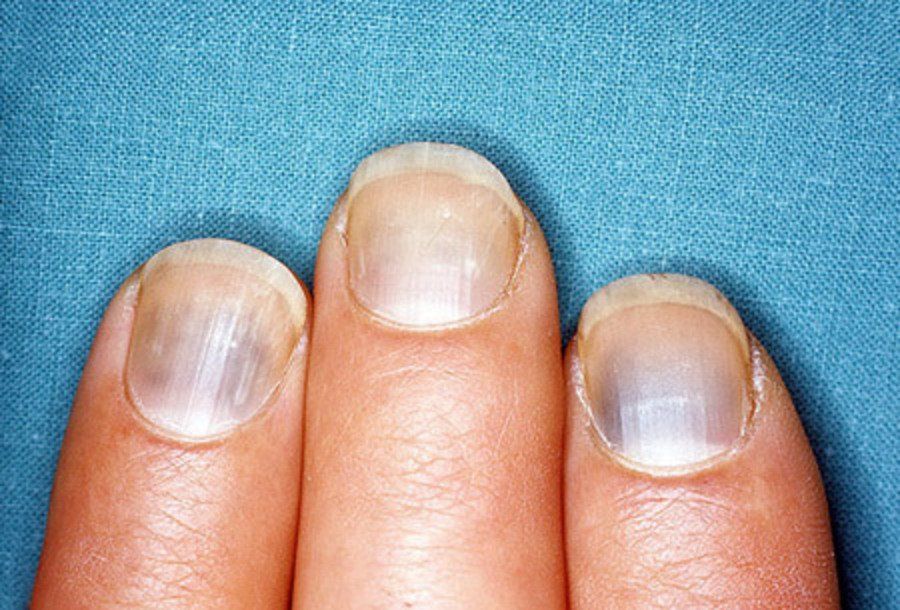 Ногти стали толстыми и твердыми. Онихорексис, ониходистрофия. Ониходистрофия (дистрофия ногтей). Посттравматическая ониходистрофия. Продольная меланонихия.