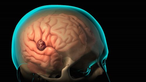 Медики поведали о трех симптомах возможно наличия рака мозга