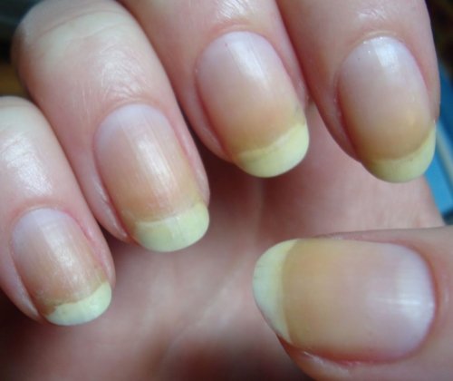 Проблемы с ногтями могут многое рассказать о здоровье человека – Медики