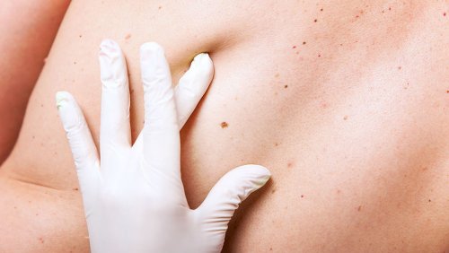 Ученые обнаружили вещество, способное предотвратить развитие рака кожи