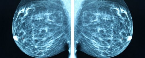 ИИ теперь официально лучше диагностирует рак молочной железы, чем эксперты