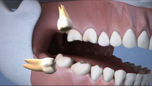 Стоматологи раскрыли, почему «не любят» зубы мудрости
