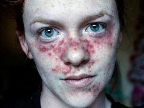 «Ужас в Америке»: Женщина за три года прошла через три типа рака кожи