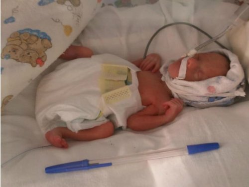 В Бурятии врачи смогли выходить новорожденную с ростом в шариковую ручку