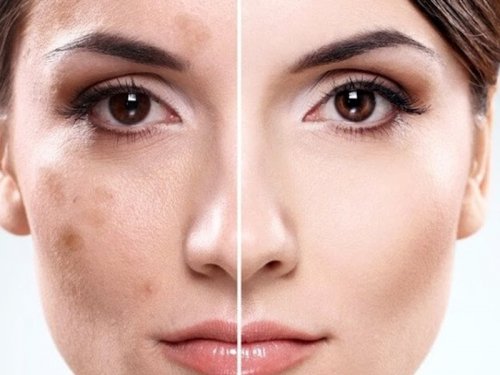 Косметологи раскрыли секрет: От пигментации кожи можно избавиться