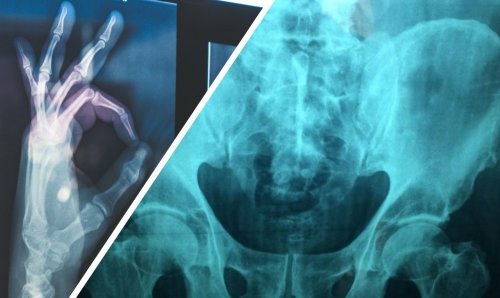 Сибирские учёные разработали уникальный имплантат для тазобедренного сустава