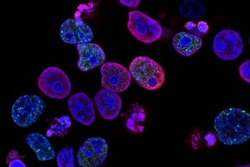 Учёные научились «взрывать» раковые клетки с помощью ультразвука